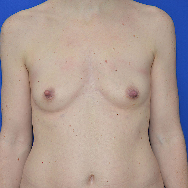 Bruststraffung mit Implantat, 39