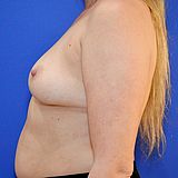 Brustvergrößerung, 44