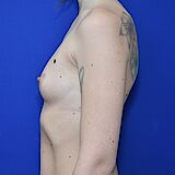 Brustvergrößerung, 31