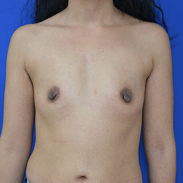 Brustvergrößerung, 36