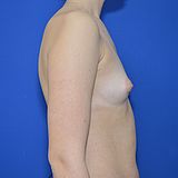 Brustvergrößerung, 20