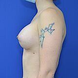 Brustvergrößerung, 39