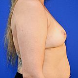 Brustvergrößerung, 44