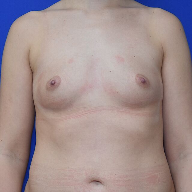 Brustvergrößerung, 27