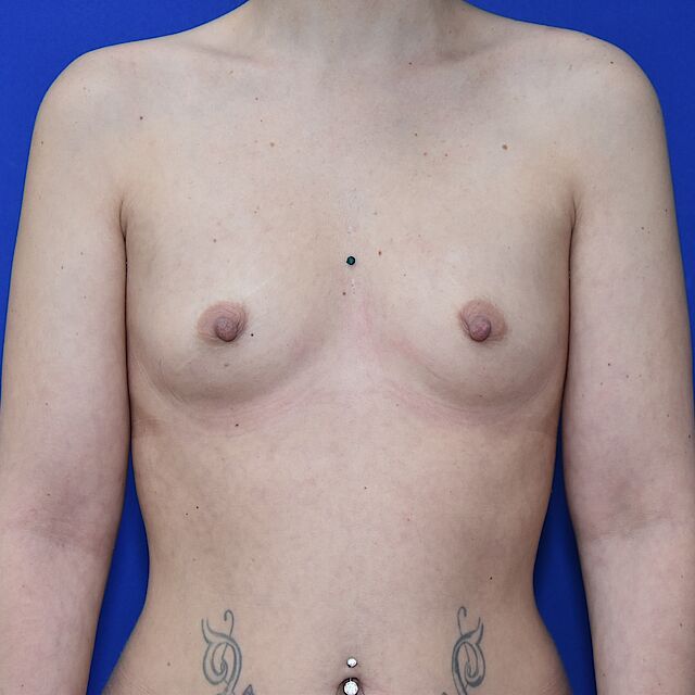 Brustvergrößerung, 31