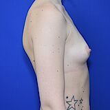 Brustvergrößerung, 31