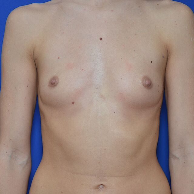 Brustvergrößerung, 29