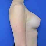 Brustvergrößerung, 29