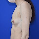 Brustvergrößerung, 33