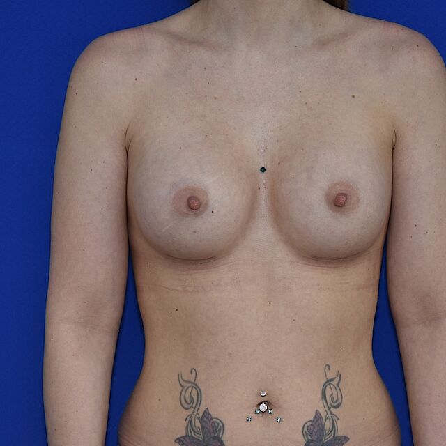 Brustvergrößerung, 31